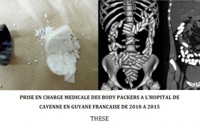 Une thèse guyanaise sur la prise en charge médicale des body-packers (mules)